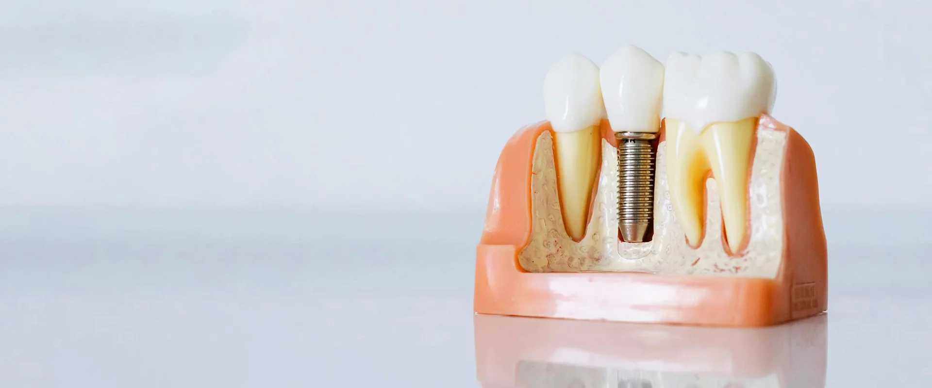 3D Dental Implant Surgery in Dubai