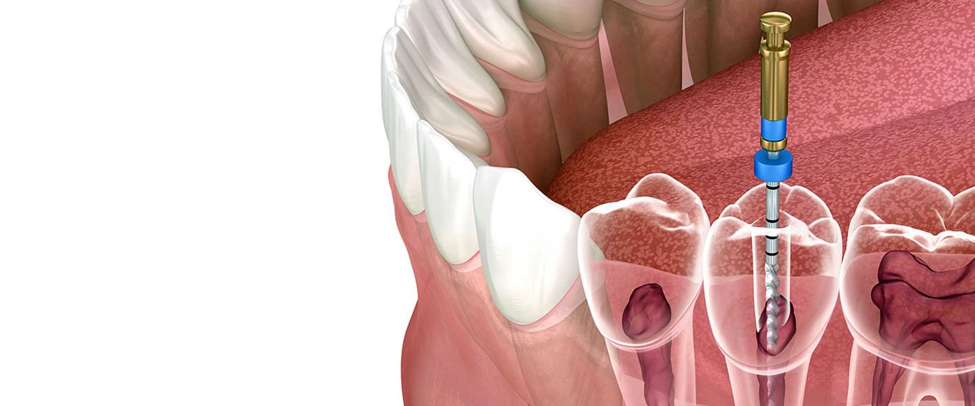 Root Canal Treatment