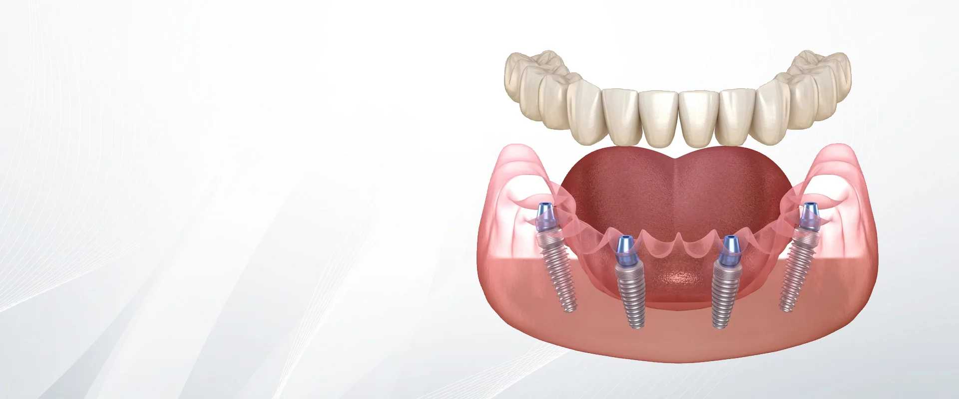 All On 4 Dental Implants