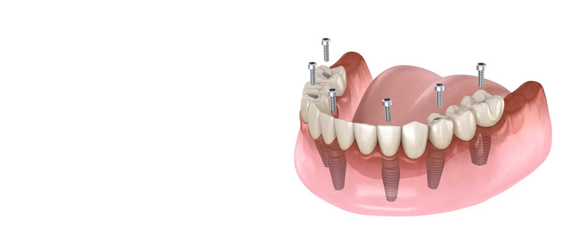 All On 6 Dental Implants