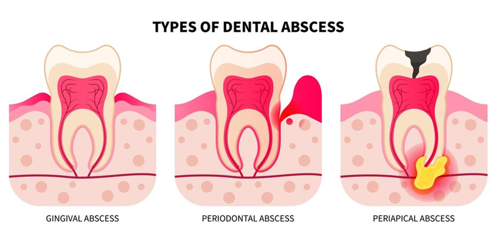 Dental Abscess