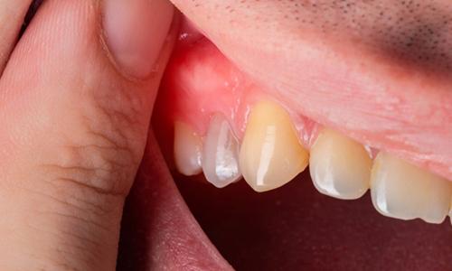 Dental Abscess