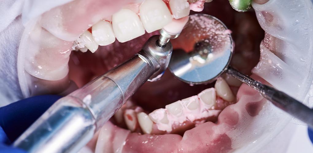 Deep Dental Cleaning