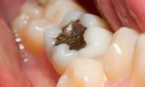 Tooth Decay Explained Risk Factors