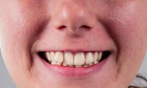 Tooth Discoloration Types Causes and Solutions