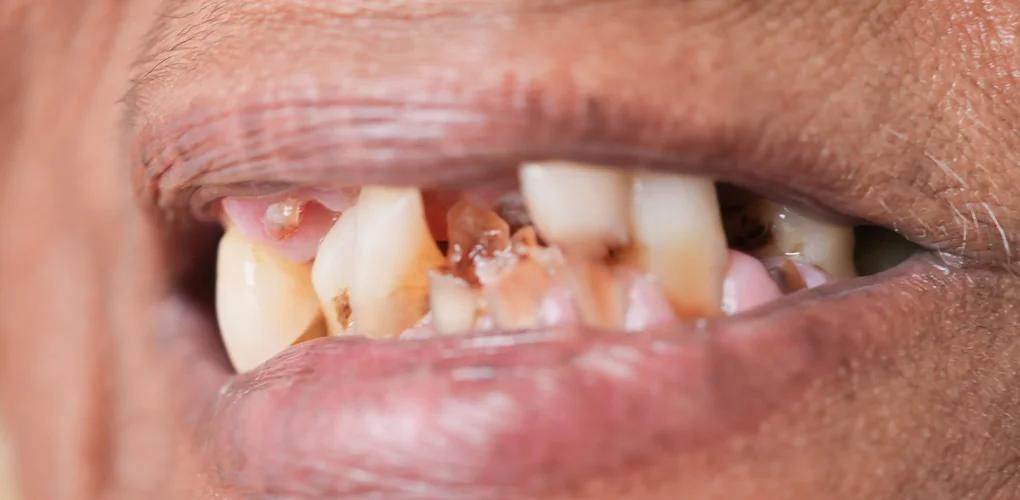 Tooth Erosion