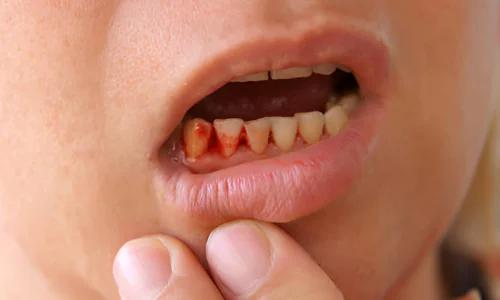 Bleeding Gums: How to Spot and Treat the Problem