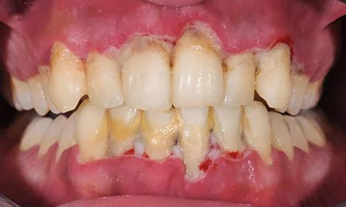 How to Prevent Gum Disease Tips for Healthy Gums