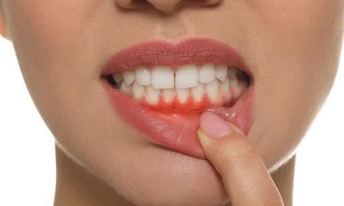 Gum Recession: Causes, Symptoms, and Treatment Options