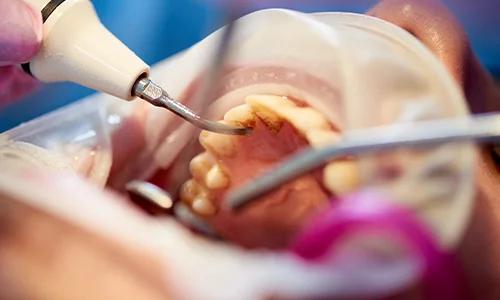 Dental Plaque Removal: Exploring the Different Types and Risks