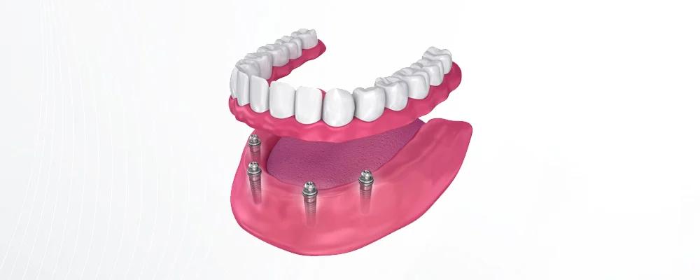 All On 4 Dental Implants