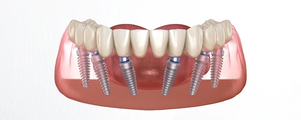 All On 6 Dental Implants