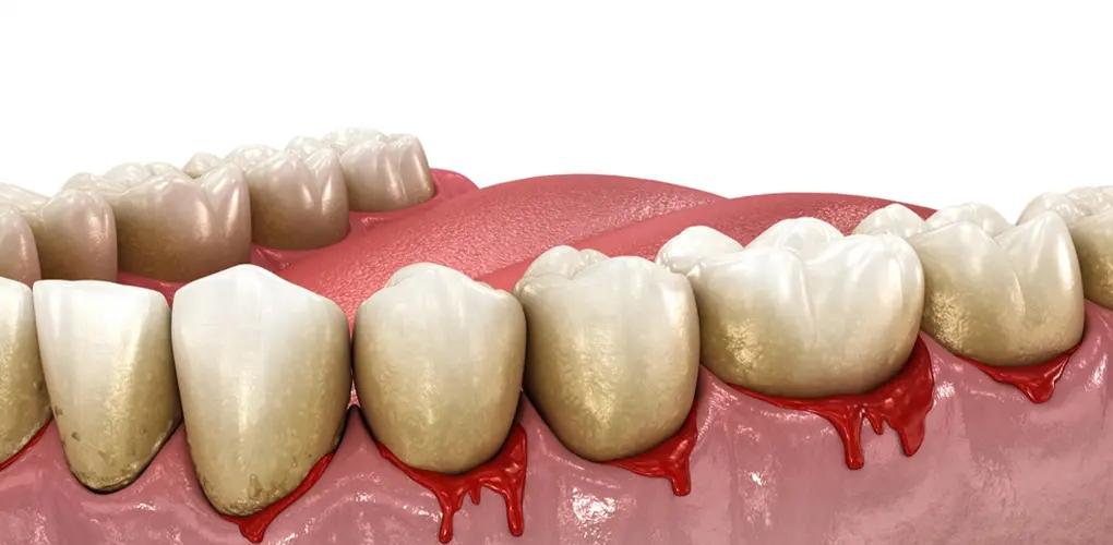 Gingivitis