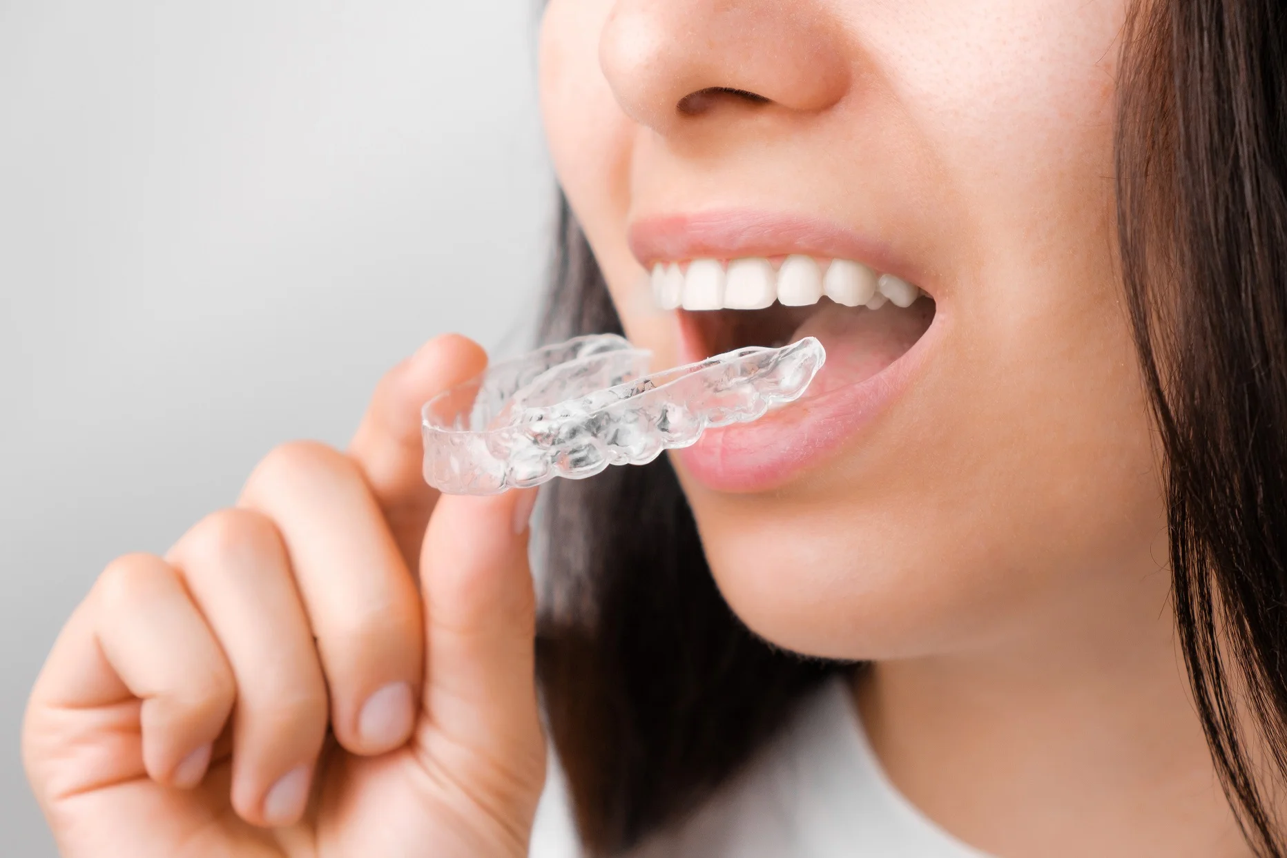 Invisalign