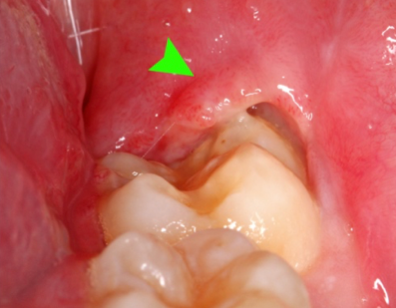 Pericoronitis