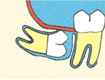 Angulated Wisdom Tooth